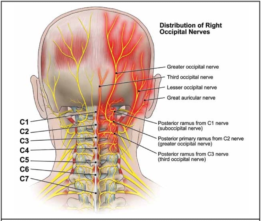 inyección de bloqueo del nervio occipital plano texas