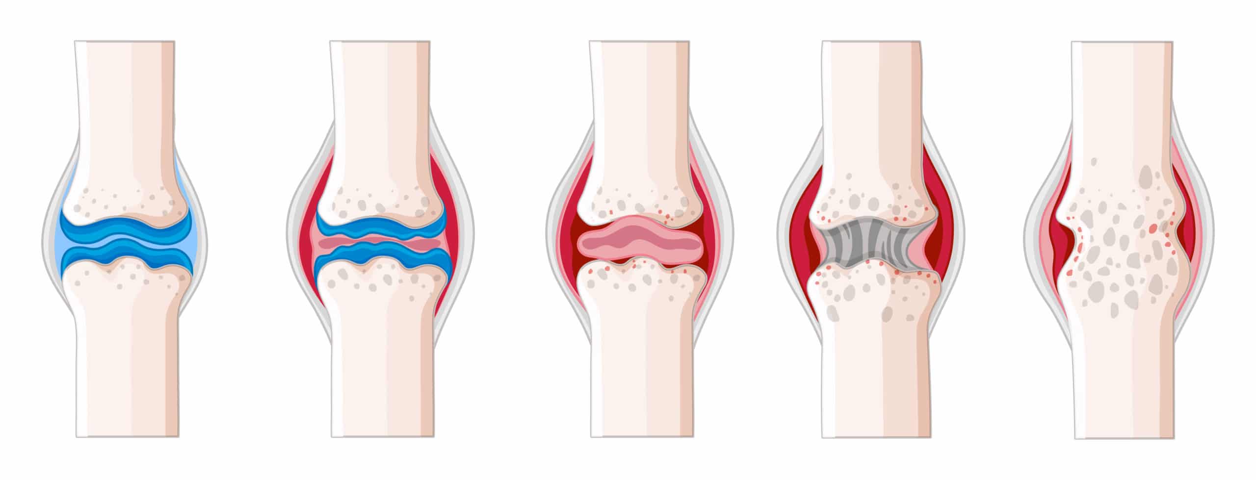Rheumatoid Arthritis Doctor in Plano DFW Treatment Options for RA