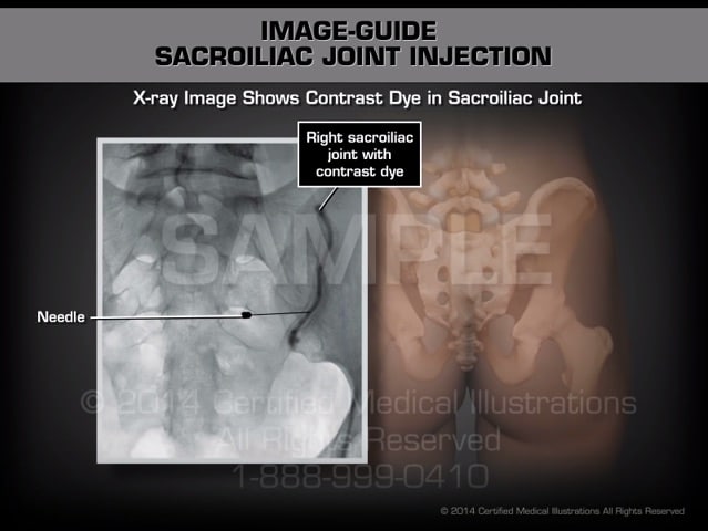 inyección en la articulación sacroilíaca